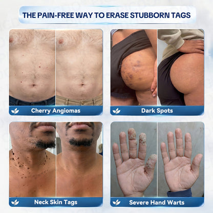 ✨👍𝐏𝐢𝐜𝐝𝐨® 7-𝐃𝐚𝐲 𝐒𝐤𝐢𝐧 𝐓𝐚𝐠 & 𝐒𝐩𝐨𝐭 𝐄𝐫𝐚𝐬𝐞𝐫 𝐂𝐫𝐞𝐚𝐦🩵 (Zero Pain, Zero 𝐒𝐜𝐚𝐫𝐬 Formula)