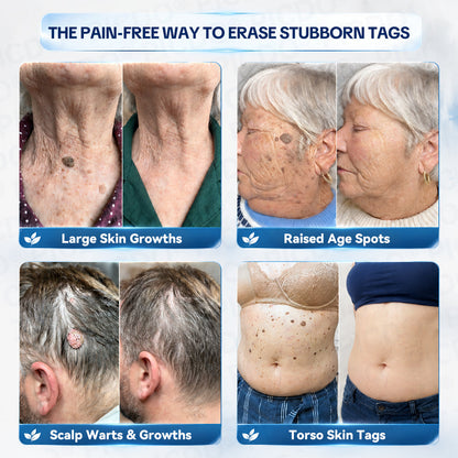 ✨👍𝐏𝐢𝐜𝐝𝐨® 7-𝐃𝐚𝐲 𝐒𝐤𝐢𝐧 𝐓𝐚𝐠 & 𝐒𝐩𝐨𝐭 𝐄𝐫𝐚𝐬𝐞𝐫 𝐂𝐫𝐞𝐚𝐦🩵 (Zero Pain, Zero 𝐒𝐜𝐚𝐫𝐬 Formula)