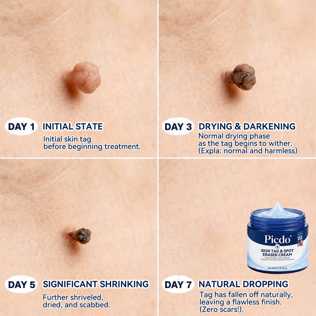 ✨👍𝐏𝐢𝐜𝐝𝐨® 7-𝐃𝐚𝐲 𝐒𝐤𝐢𝐧 𝐓𝐚𝐠 & 𝐒𝐩𝐨𝐭 𝐄𝐫𝐚𝐬𝐞𝐫 𝐂𝐫𝐞𝐚𝐦🩵 (Zero Pain, Zero 𝐒𝐜𝐚𝐫𝐬 Formula)