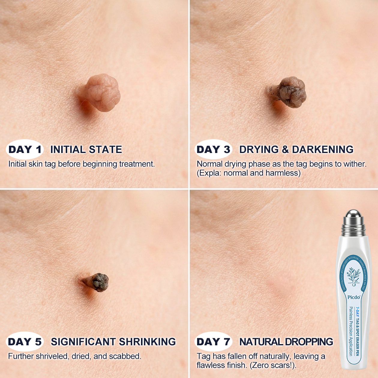 ✨👌𝐏i𝐜𝐝o® 7-𝐷𝑎𝑦 𝗧𝐚𝐠 & 𝗦𝗽𝐨𝐭 𝐄𝐫𝒂𝒔𝒆𝒓(Zero Pain, Zero 𝐒𝐜𝐚𝒓𝒔 Rollerball)